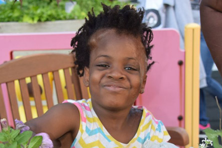 un patient souriant avec des cicatrices de brûlure