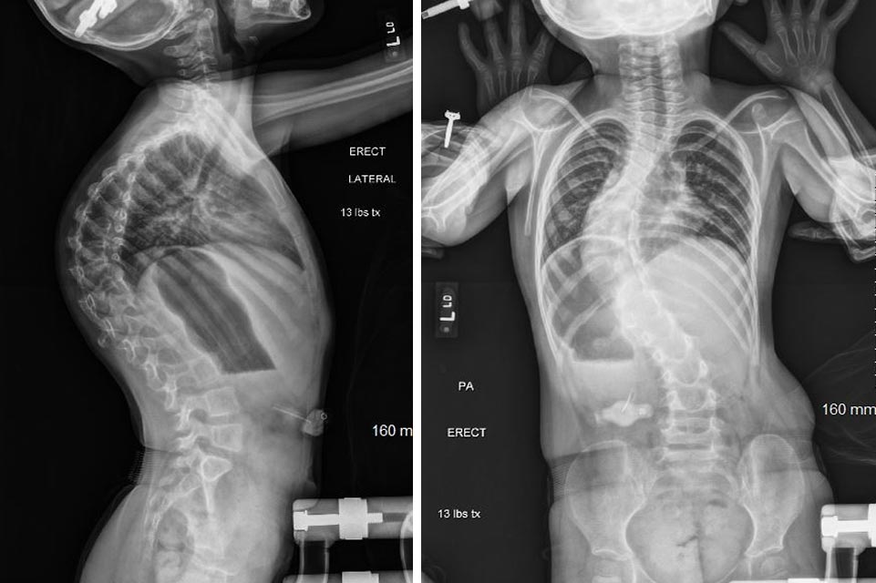 back and side X-rays of Kennedy's back