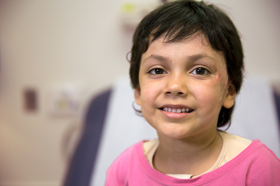 female patient with burn scars